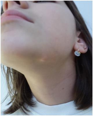 Case report: Abrikossoff's tumor of the facial skin